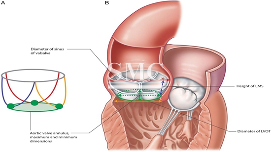 Sapien 3 Transcatheter Heart Valve